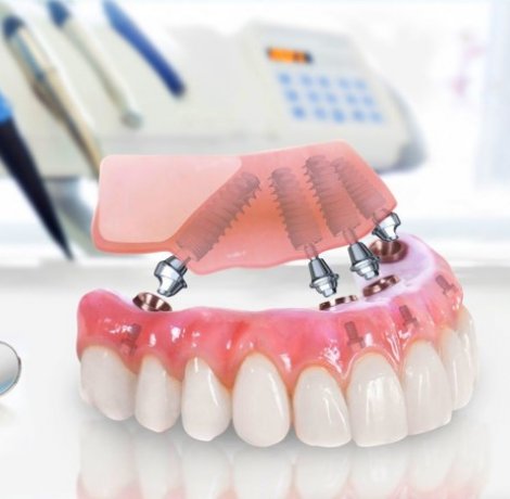 Dental Prostheses